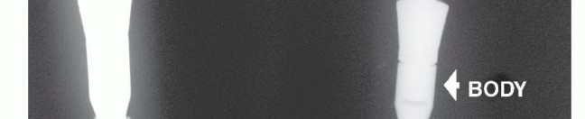 Illustration 2 for Distal Humeral Resection: Safe Techniques for Limb Preservation