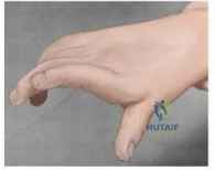 Vascularized Bone Grafts in Carpal Reconstruction: The Zaidemberg Technique and Capitate Fractures