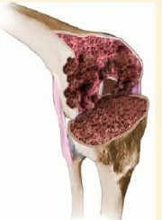 Illustration 2 for Femoral Bone Loss: Metal Augments for Revision Knee Success