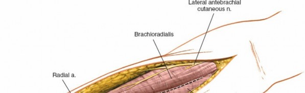 Illustration 6 for Radius Anterior Approach: Safe Nerve Protection & Complete Exposure