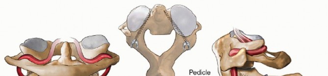 Illustration 21 for Master Techniques for Cervical Fracture Reduction: Type III & More