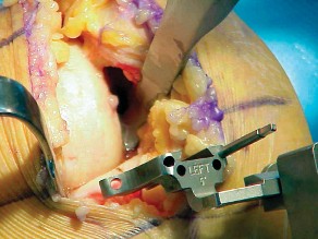 صورة توضيحية لـ تقويم مفصل الركبة أحادي الحجرة دليل شامل للمرضى في صنعاء