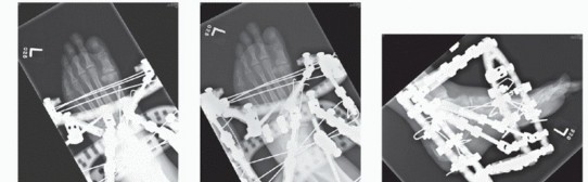 Illustration 67 for Mastering Midfoot Arthrodesis: Protect the Deep Neurovascular Bundle