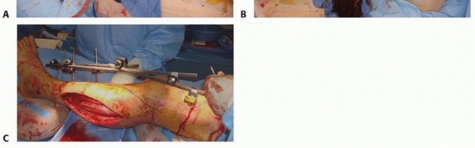 Illustration 22 for Tibia External Fixation: See How Pins Are Placed for Healing