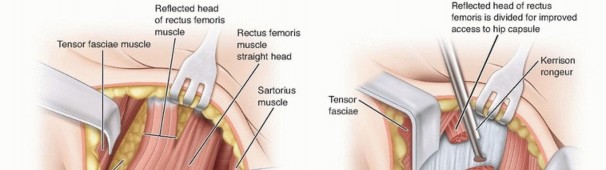 Illustration 12 for Septic Hip in Children: Mastering Anterior Drainage for Optimal Recovery