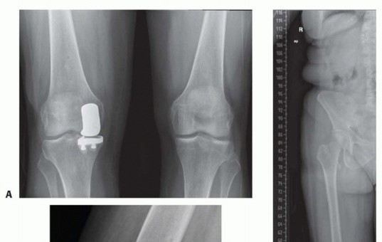 صورة طبية: استبدال مفصل الركبة الجزئي: حل متقدم لآلام الركبة المستمرة مع الأستاذ الدكتور محمد هطيف