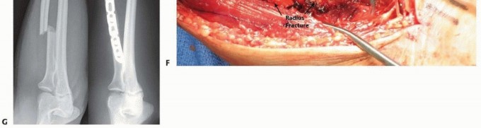 Illustration 18 for Optimal ORIF for Diaphyseal Forearm Fractures: Your Guide