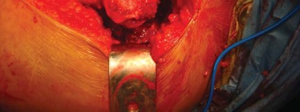 Illustration 12 for The Silent Hip: Achieving a Truly Silent, Pain-Free Joint