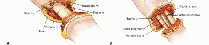 Illustration 22 for Above-Elbow & Below-Elbow Amputations: When & Why They're Needed