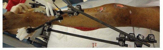 Illustration 13 for Tibia External Fixation: See How Pins Are Placed for Healing