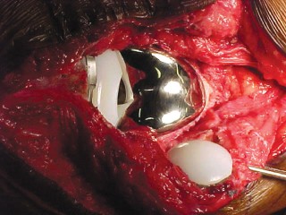 Illustration 19 for Solving Severe Bone Loss: Tantalum for Patellar Reconstruction
