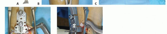 Illustration 13 for HINTEGRA Total Ankle: Unlocking Natural Ankle Movement