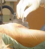 Illustration 22 for Knee Arthroplasty Unicondylar: Discover if Partial Knee Replacement is Right