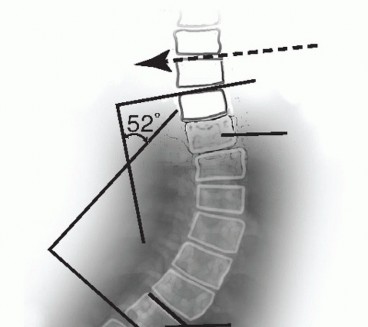 Illustration 5 for Adult Scoliosis: Uncover Causes & Find Lasting Back Pain Relief