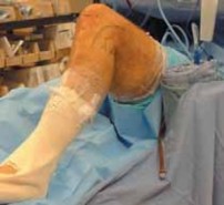 Illustration 5 for Cruciate Ligament Repair: Definitive Guide to Treatment & Recovery