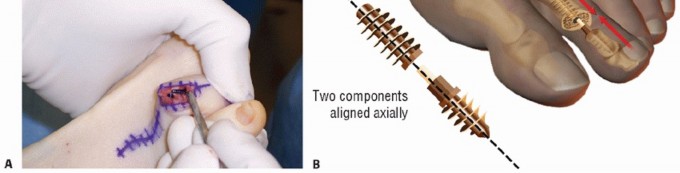 Illustration 36 for Hammer Toe Correction: Understanding the Extensor Digitorum Longus