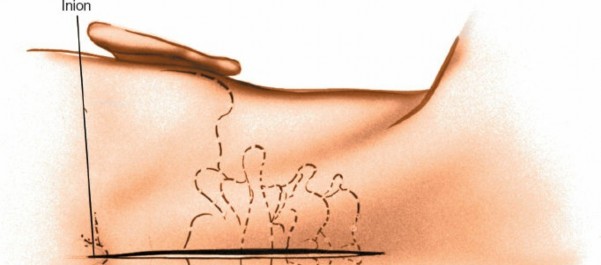 Illustration 222 for Approach to the Lumbar Spine: Mastering Techniques & Anatomy