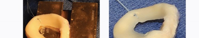 Illustration 12 for Symptomatic Knee? Meniscal Transplant for Anterior & Posterior Horns