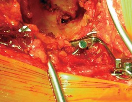Illustration 47 for Cemented Component Longevity: The Critical Margin of the Acetabulum