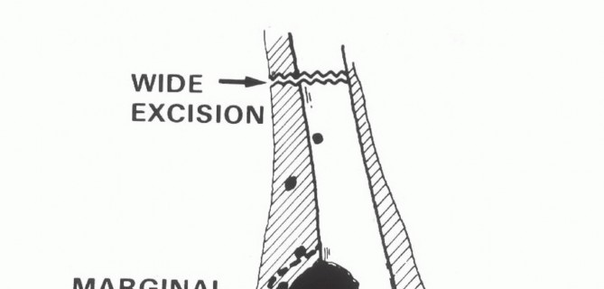 Illustration 19 for Advanced Distal Femoral Resections: Limb-Sparing Outcomes & Techniques