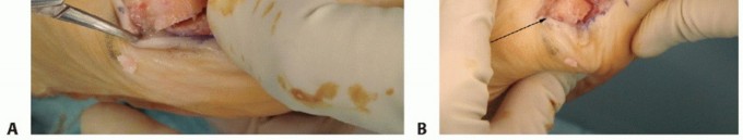 Illustration of distal chevron osteotomy - Dr. Mohammed Hutaif