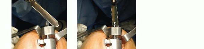 صورة توضيحية لـ استبدال مفصل الركبة الجزئي: حل متقدم لآلام الركبة المستمرة مع الأستاذ الدكتور محمد هطيف