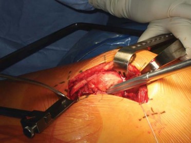 Illustration 73 for Successful Total Hip Replacement in Developmental Dysplasia