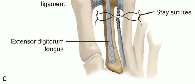 Illustration 11 for Toe Deformity Pain? Rebalance Flexor to Extensor for Relief