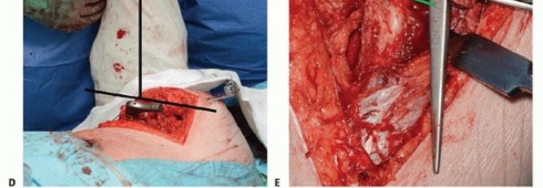 Illustration 39 for Special THA Techniques for Severe Deformities Around the Hip
