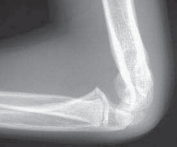 Supracondylar Osteotomy: Achieving Optimal Correction of Cubitus Varus
