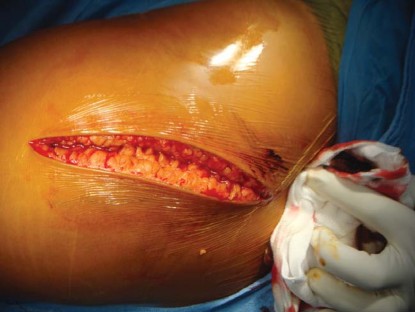 Illustration 8 for The Silent Hip: Achieving a Truly Silent, Pain-Free Joint