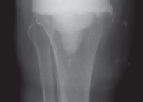 Illustration 38 for PROSTALAC Articulating Spacer: Treat Infected Knees, Regain Mobility
