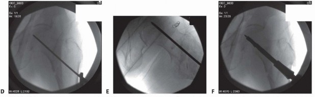 Illustration 14 for ORIF for Peritrochanteric Hip Fractures: Achieve Stable Mobility