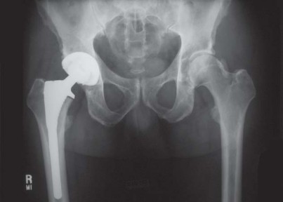 Illustration 31 for Avoiding Errors: Navigation in Total Hip Arthroplasty