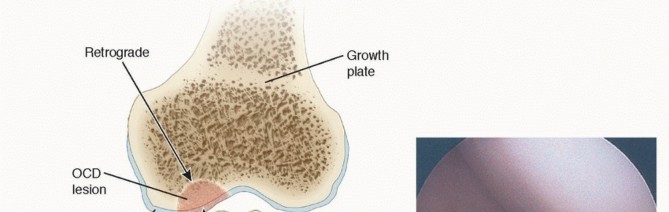 Illustration 26 for Dissecans of the Knee: What's the Difference – OCD vs. AVN?