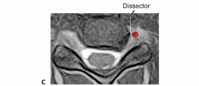 Illustration 19 for How ACDF Clears Your Posterior Disc Space for Lasting Relief