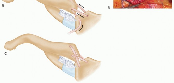 Illustration 26 for Optimizing SC Dislocation Repair After Medial Clavicle Resection