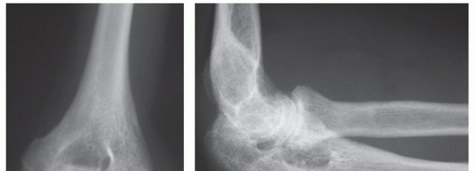 Total Elbow Arthroplasty: Alleviating Pain for Patients with RA