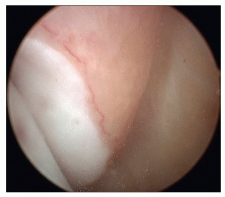 Illustration 14 for Medial Ankle Instability: Find Relief with Reconstruction