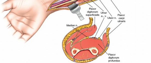Illustration 97 for Mastering Approaches to the Upper Third of the Radius