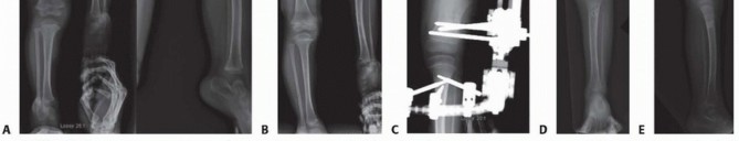 Illustration 34 for Treatment for Congenital Femoral Deficiency: What You Need to Know