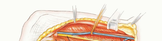 Illustration 13 for Optimizing Adductor Muscle Group Resection for Limb Preservation