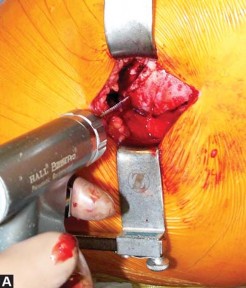 Illustration 18 for Exploring the Ambulatory Surgical Setting for Total Hip Replacement