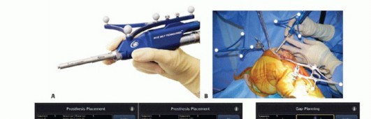 صورة طبية: استبدال مفصل الركبة الجزئي: حل متقدم لآلام الركبة المستمرة مع الأستاذ الدكتور محمد هطيف