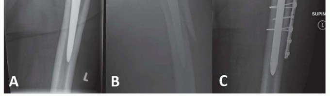 Illustration 6 for Mastering Fixation of Periprosthetic Fractures of the Femur