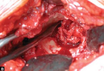 Illustration 2 for Optimizing Acetabular Component Cementation for Superior Outcomes