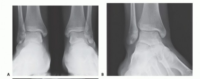 Osteochondral Transfer: Superolateral Femoral Condyle Grafts for OLTs