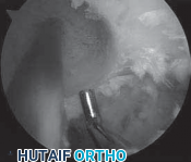 Illustration 15 for Successful Ligament Repair Revision: Fixing Failed ACLs