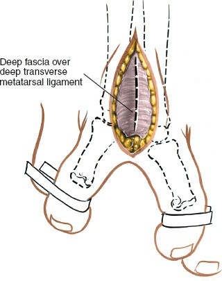 Illustration 225 for Optimized Approaches to the Dorsum of the Foot & Ankle
