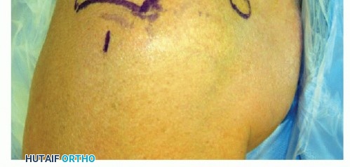 Illustration 6 for Find Relief: Arthroscopic Subacromial Decompression for Impingement